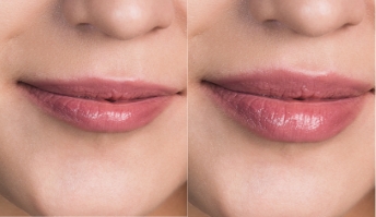 Lip fillers results 01