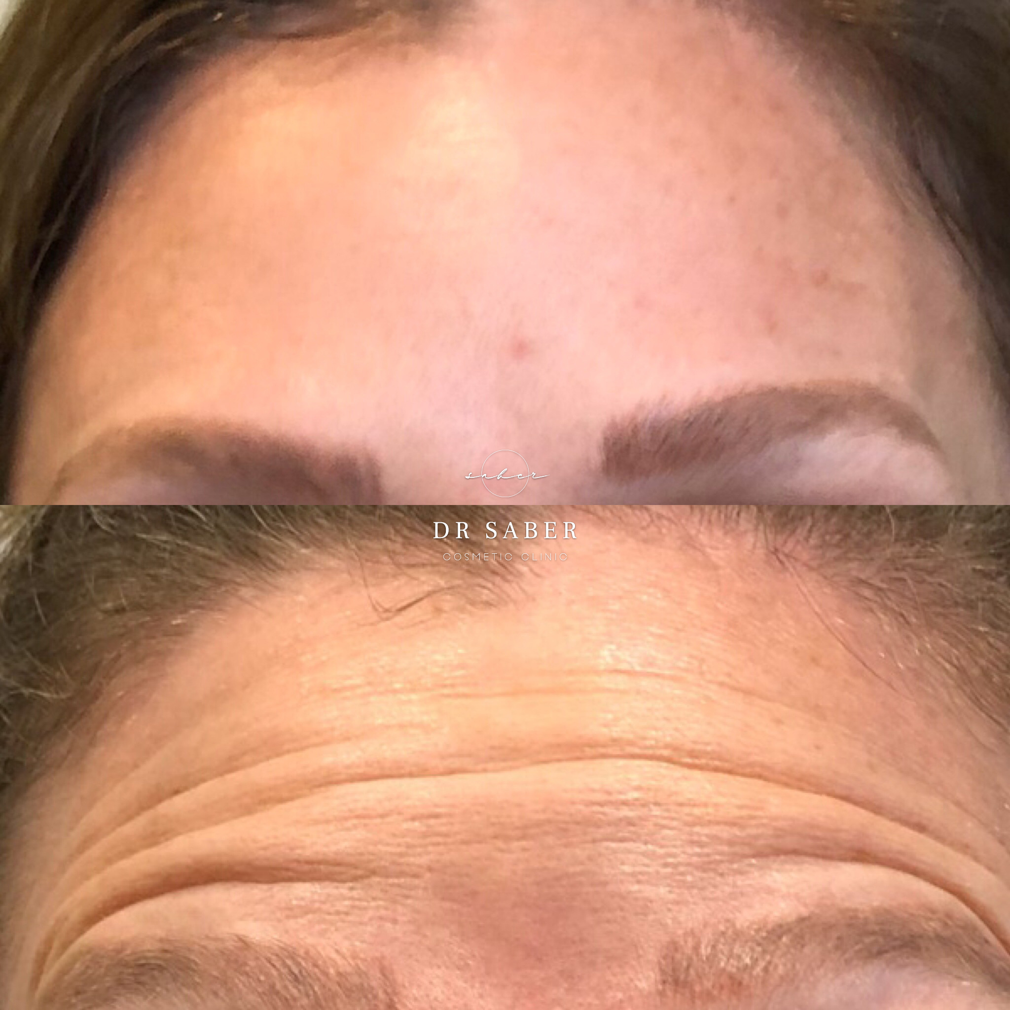 Anti-Wrinkle-Injections