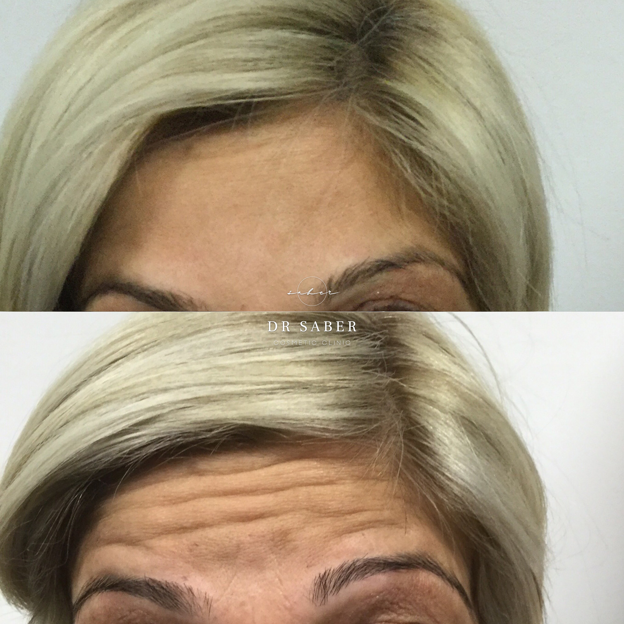 Anti-Wrinkle-Injections